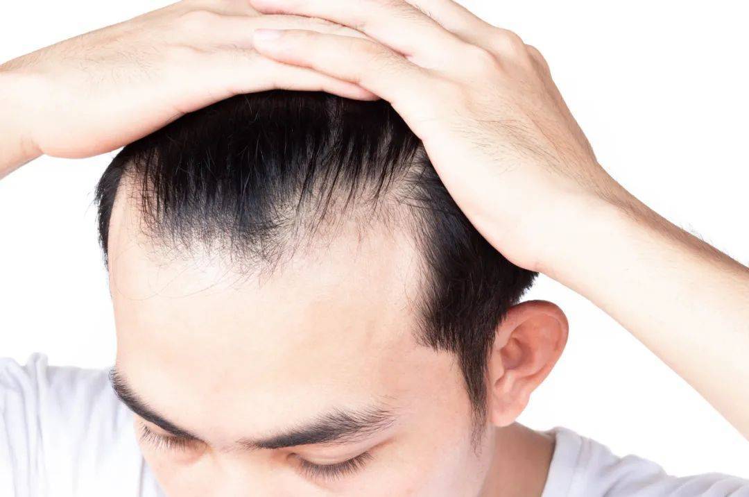 男性脱发根本原因是什么?雄激素过多导致脂溢性脱发