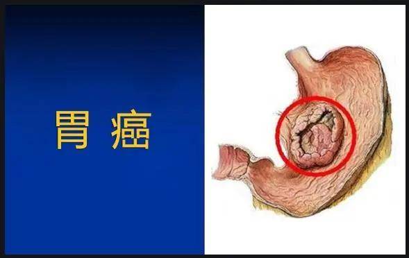 从胃病到胃癌的**症状，胃溃疡就是早期发出的信号