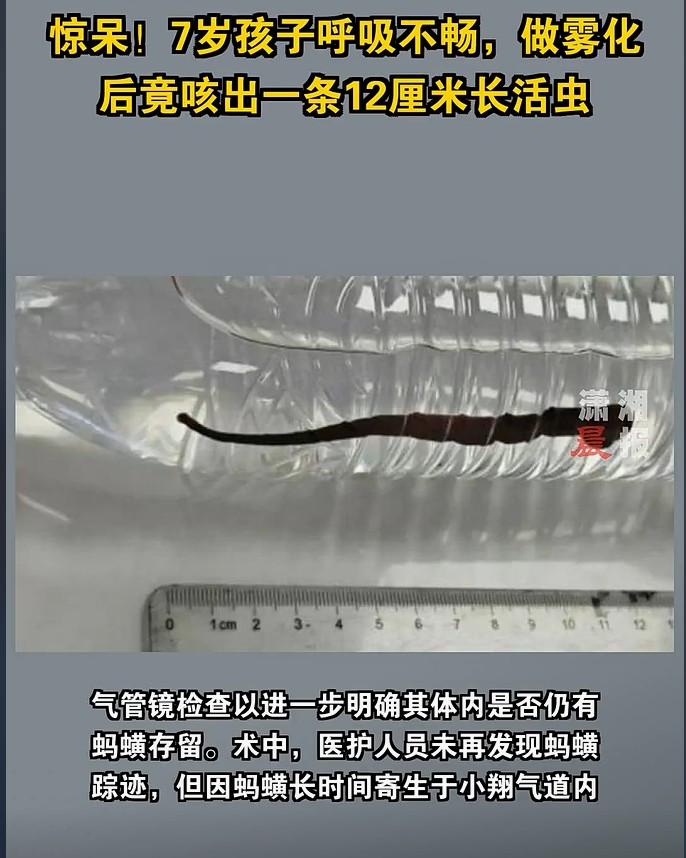 惊！幼童做雾化竟咳出一条活体蚂蟥，肺部严重感染